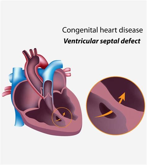 6 Types Of Congenital Heart Disease In Children Signs And Causes