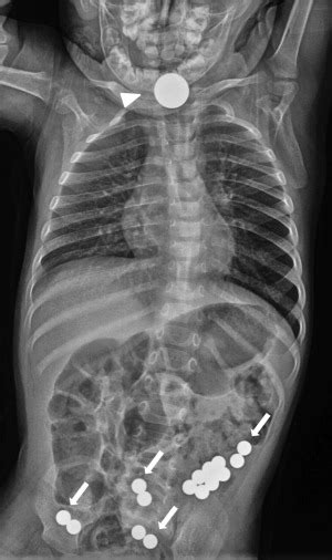 Neonatal And Pediatric Bowel Obstruction Radiologic Clinics