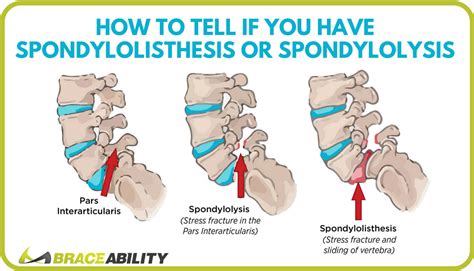 Do I Have Lumbar Spondylolisthesis Or Spondylolysis