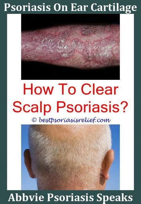 Scalp Psoriasis What You Need To Know To Feel Better Scalp Psoriasis