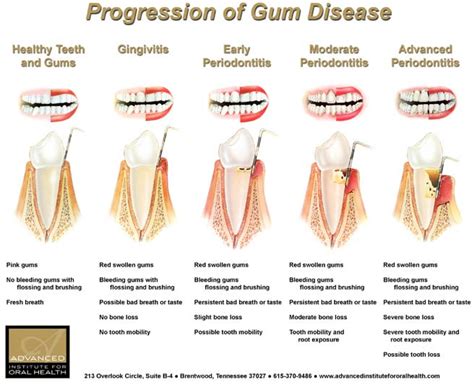 Gum Disease Gingivitis Causes Risk Factors Symptoms And Treatment