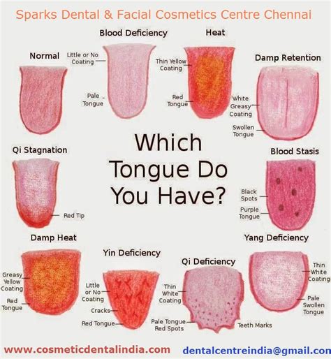 Which Tongue Do You Have Tongue Health Tongue Sores Tongue Problems