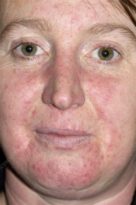 Rosacea Skin Disorder Stock Image M2500058 Science Photo Library