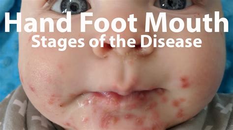 Hand Foot And Mouth Disease Hfmd Symptoms And Duration Youtube