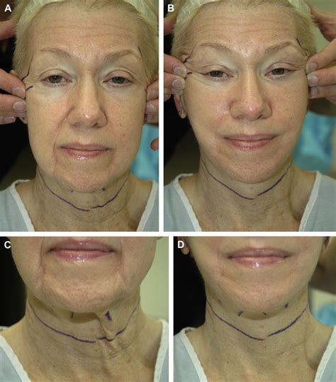 The Modern Minimally Invasive Face Lift Plastic Surgery Key