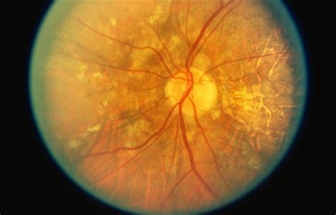 Angioid Streaks From Pxe With Choroidal Atrophy Retina Image Bank