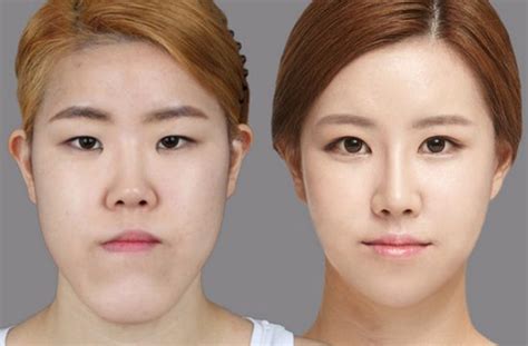 Crazy Before And After Photos Of South Korean Plastic Surgery Sick