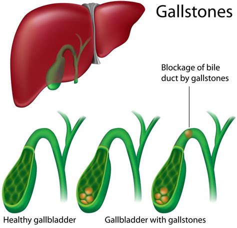 What Are The Signs Of A Gallbladder Attack With Pictures