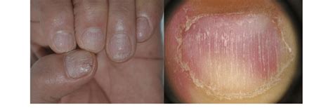 Nail Fragility Due To Alopecia Areata Of The Nails With Regular Thin
