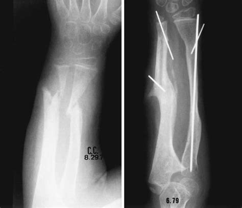 Congenital Pseudarthrosis Of Both Forearm Bones Long Term Results Of