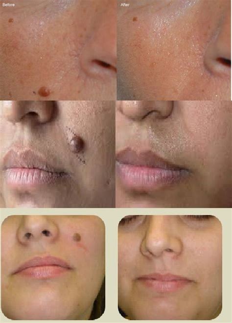 Mole Removal Without Injury And Scaring With Guaranteed Results Book