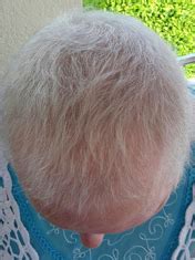 Haarausfall Durch Chemotherapie Alopecia Medicamentosa THYMUSKIN