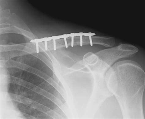 The Broken Clavicle Or Collar Bone Four Myths You Need To Understand