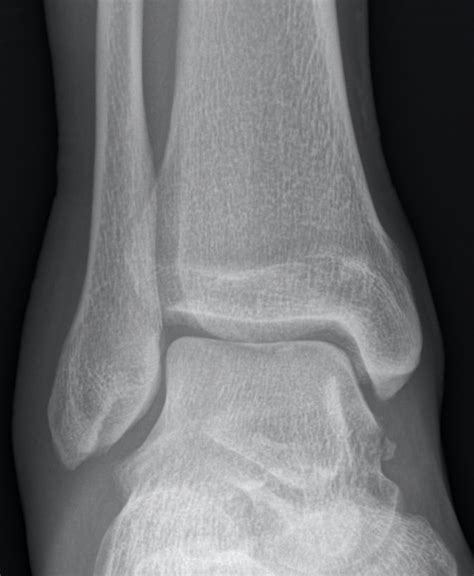 Cedell Fracture • Litfl • Medical Eponym Library