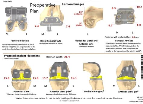 Case Study Custom Total Knee Replacement In Left Knee Arthritis With