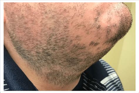 Patches Of Alopecia Areata Of The Beard Of Patient 1 Before Treatment