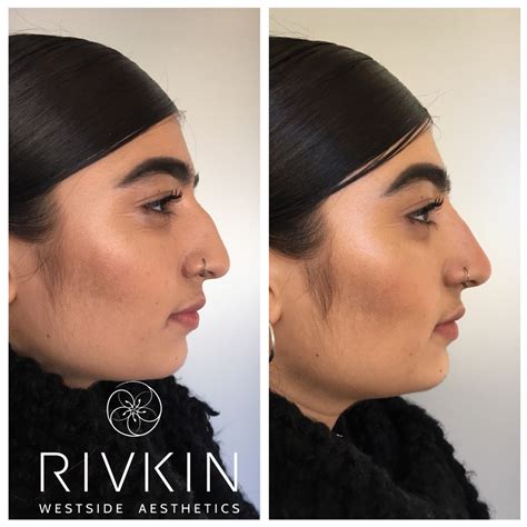 Non Surgical Nose Job By Drrivkin Voluma Was Used To Mask The Bump