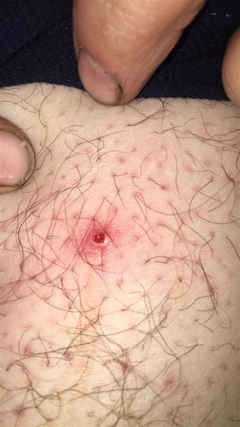 According to the nhs an ingrown hair can occur when the hair follicle becomes clogged with dead skin cells. Popped an ingrown hair on my boyfriends leg and it left a ...