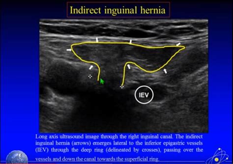 Indirect Vs Direct Inguinal Hernia