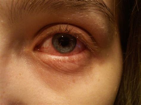 Tipos De Infecciones En Los Ojos Y Como Curarlas En Casa