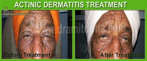 Actinic Dermatitis Dr Amit Dutta Best Ayurvedic Doctor And Skin