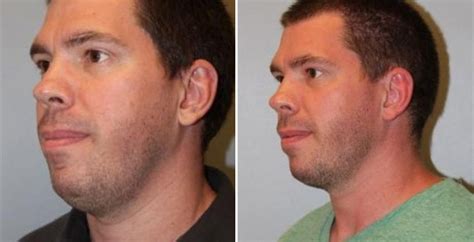 Attn Men We Can Totally Help You Eliminate Your Double Chin 😀