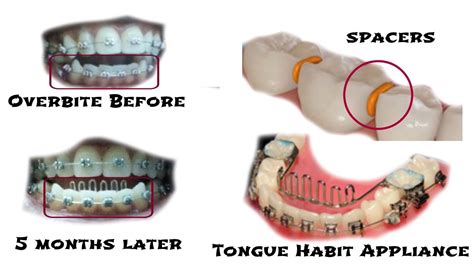 This is where you'll attach your rubber bands. BRACES UPDATE ( 5 MONTHS ): Overbite, Rubberbands, Tongue ...