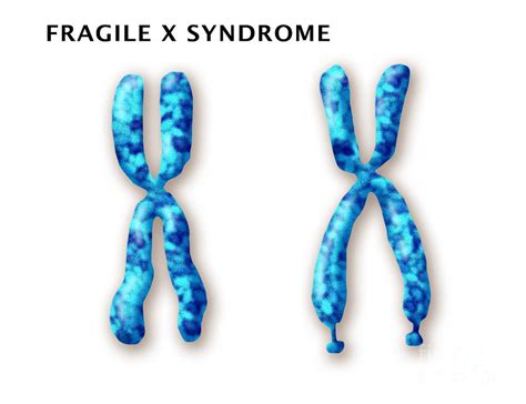 Fragile X Syndrome Causes Symptoms Diagnosis And Treatment Online