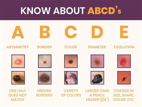 Understanding The Different Types Of Skin Cancer Treatment Zeeva Clinic