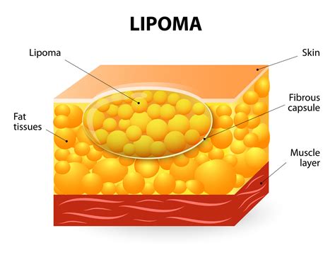 Lipomas Causes And Treatment Methods Woodbury General Surgeon