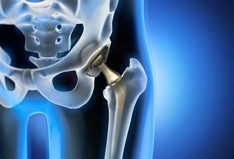 Advantages And Disadvantages Of Anterior Hip Replacement Surgery