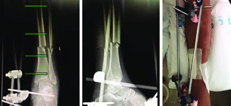 Fracture Of Distal Tibia Treated With An External Fixator Ef Bridging