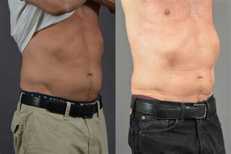 Sculpsure Before And After Long Island Dr Marotta