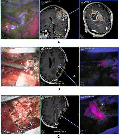 A Intraoperative Screenshots Of The Neuro Navigation At The Beginning Download Scientific