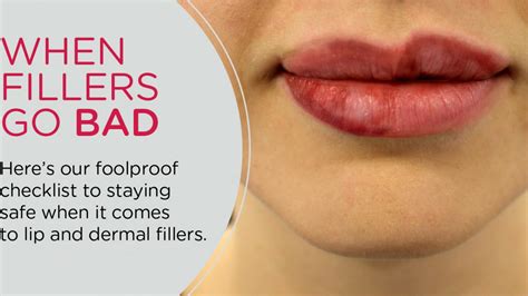 How To Get Rid Of Lumps After Lip Filler