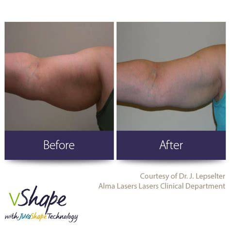 Body Contouring Sculpting For Arms And Hands Juvashape Columbus