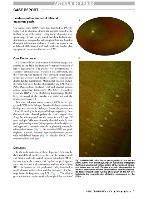 Pdf Fundus Autofluorescence Of Bilateral Ora Serrata Pearls