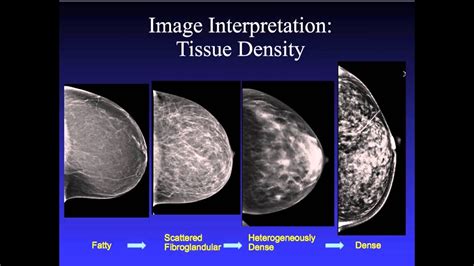 Introduction To Mammography Youtube