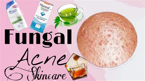 How To Cure Fungal Acne Or Tiny Bumps Skincare Tips💕 Youtube