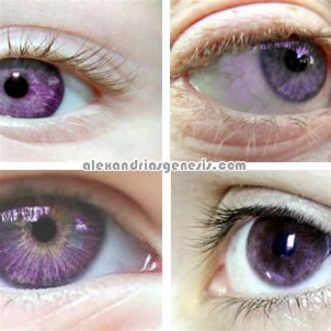 Alexandrias Genesis Purple Eyes Syndrome Pictures Alexandrias Genesis