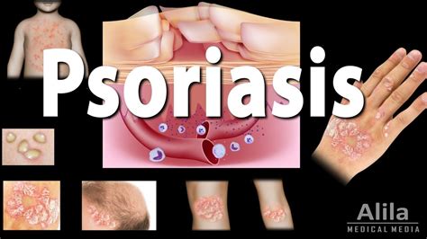 Psoriasis Types Symptoms Causes Pathology And Treatment Animation Youtube