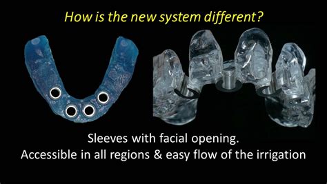The growing interest in flapless surgery in conjunction with immediate loading for edentulous patients has led to the development of software programs that. Simplified Computer Guided Surgery Preview