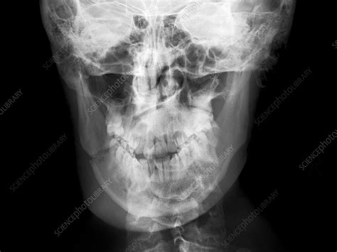 Broken Jaw X Ray Stock Image C0177558 Science Photo Library