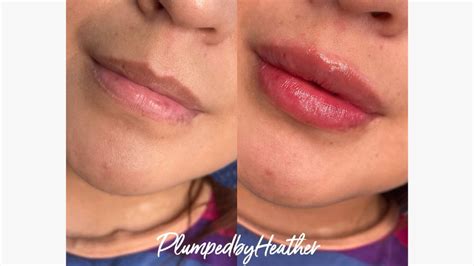 Kipihent Féreg Habitat Hyaluronic Acid Lip Filler Kanyarog Sör Átgázol