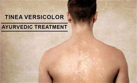 Tinea Versicolor Treatment In Ayurveda Fastest Way To Cure