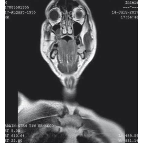 Image Captured From Left Modified Radical Neck Dissection Showing A