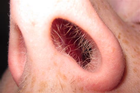 Eine entzündung in der nase kann verschiedensten ursachen haben. Nasenhaar - Wikiwand