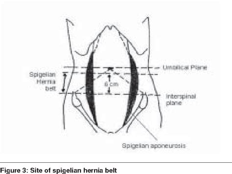 Figure 2 From Diagnosis And Management Of Spigelian Hernia A Review Of