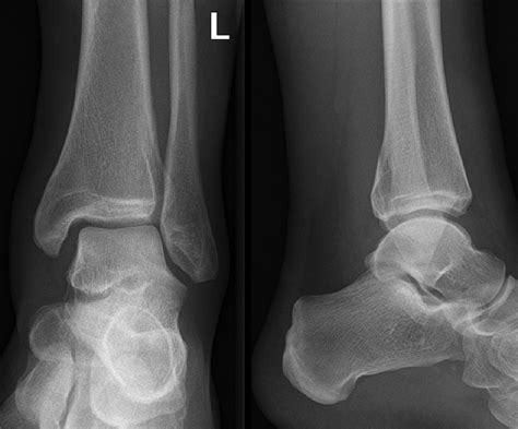 Mortise And Lateral View X Ray Of Left Ankle Mortise And Lateral View