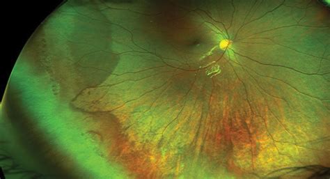 Ultra Widefield Imaging Ideal For Monitoring Myopic Maculopathy